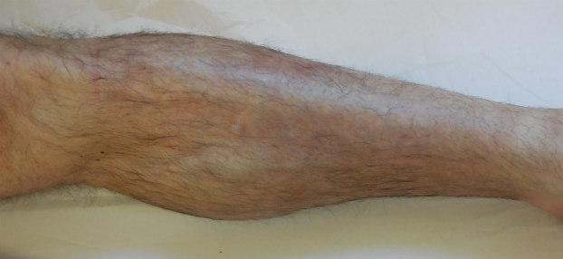 Ekzem nach 2 Woche lokaler Behandlung bei Hautarzt Prof. Dr. Okamoto in Wien