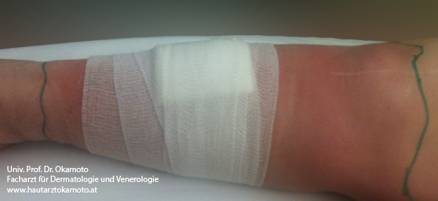 Rotlauf Behandlung in Wien bei Hautarzt Prof. Dr. Okamoto