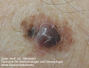 Melanom - Behandlung in Wien bei Hautarzt Prof. Dr. Okamoto