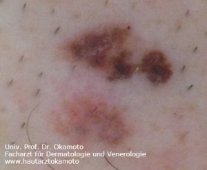 Melanom - Behandlung in Wien bei Hautarzt Prof. Dr. Okamoto
