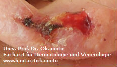 Plattenepithelkarzinom - Behandlung in Wien bei Hautarzt Dr. Okamtoto