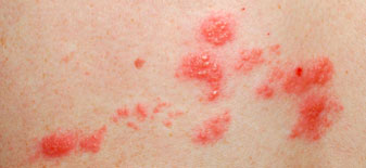 Haut mit Herpes Zoster