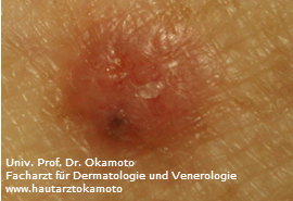Basaliom - Behandlung in Wien bei Hautarzt Dr. Okamoto