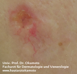 Basaliom - Behandlung in Wien bei Hautarzt Dr. Okamoto