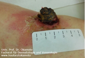 Melanom - Behandlung in Wien bei Hautarzt Prof. Dr. Okamoto