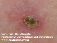 Plattenepithelkarzinom - Behandlung in Wien bei Hautarzt Prof. Dr. Okamoto