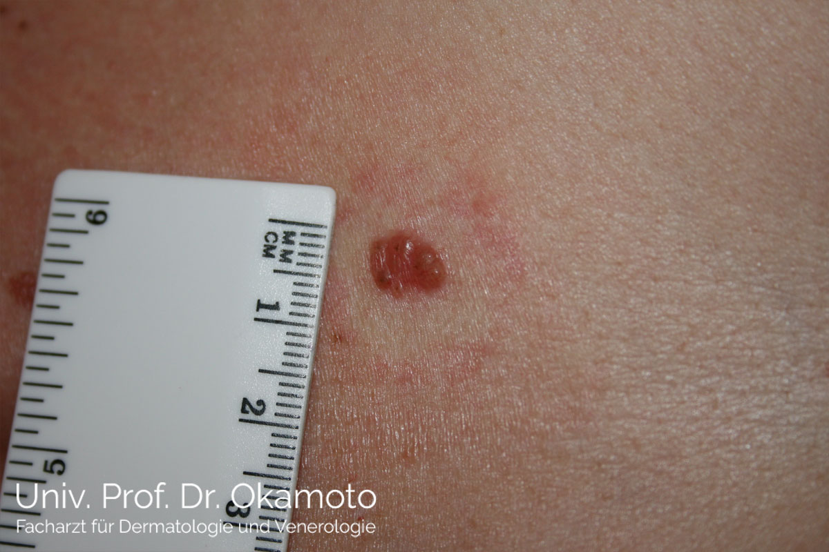 Basaliom - Behandlung in Wien bei Hautarzt Prof. Dr. Okamoto