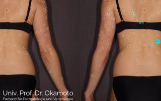 Bodyscan Hautkrebsvorsorge Hautarzt Okamoto Wien