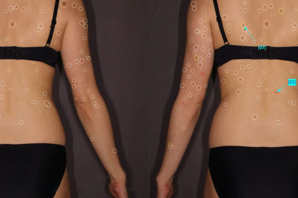 Muttermalkontrolle mit Total Body Mapping: Rückenaufnahmen mit markierten und nummerierten Muttermalen zur Verlaufskontrolle