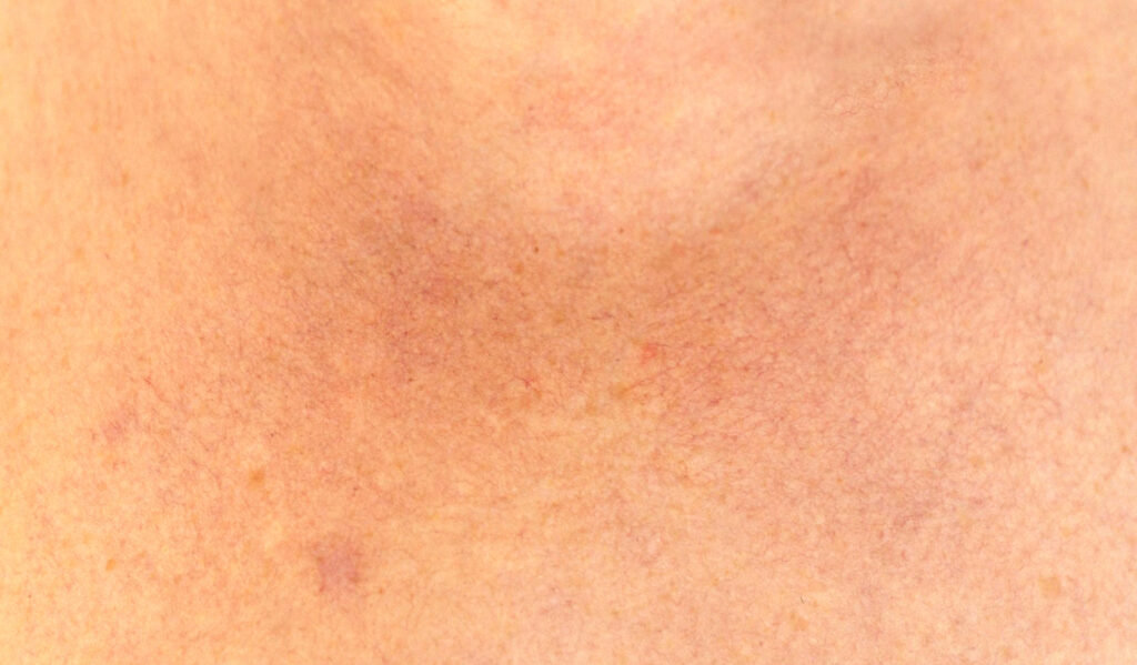 Nahaufnahme der Haut bei Rosacea mit flächiger Rötung und feinen, erweiterten Äderchen